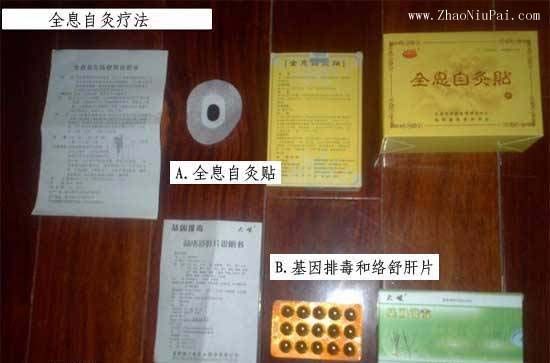 全息自灸疗法